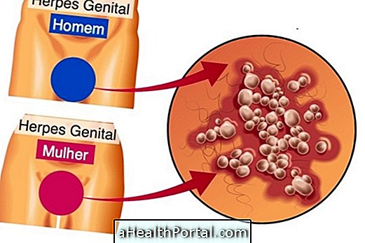 Kuidas tekib genitaalherpes
