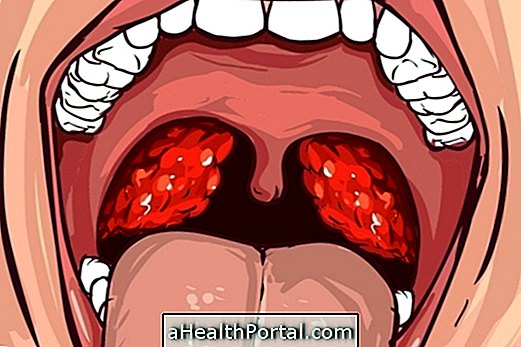 Bakteriel tonsillitis: hvad det er, hovedsymptomer og hvordan behandlingen er færdig