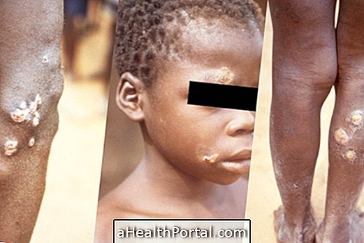 Bouba-Hautkrankheit - Identifizieren und Behandeln