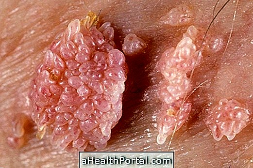 Treatment for Genital Warts