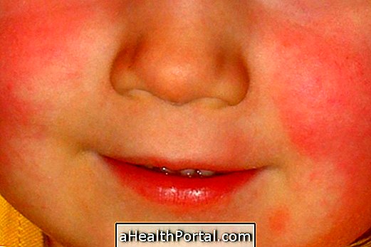 What is scarlet fever and major symptoms