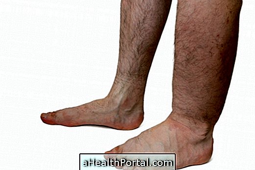 What is Elephantiasis and how to prevent it