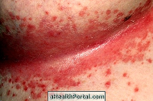 Symptoms and Treatment for Candidiasis Under the Breast