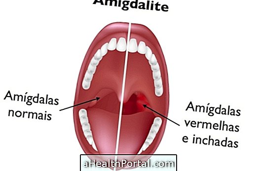 Sådan identificeres og behandles tonsillitis