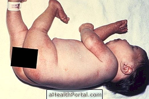 Hvad er Congenital Multiple Arthrogryposis (AMC)