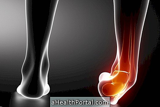 How To Treat Ankle Dislocation At Home
