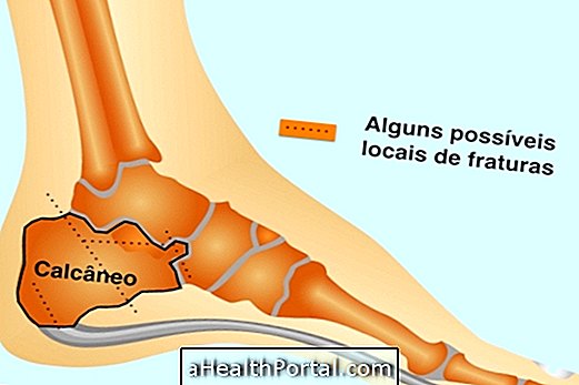How is Heel Fracture Recovery?