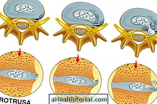 All about Herniated Disc