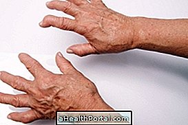 Alt om arthritis