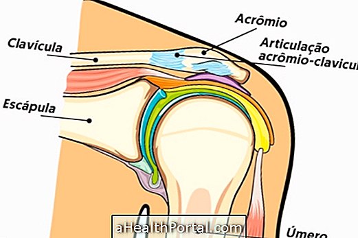 Kaj je akromionska klavikularna artroza