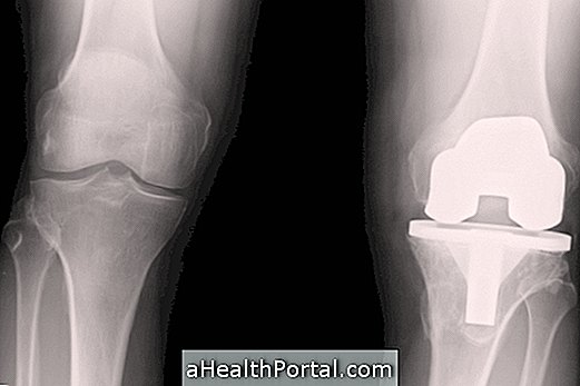 Comment se passe la chirurgie de prothèse de genou?
