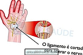 All About Carpal Tunnel Syndrome Surgery
