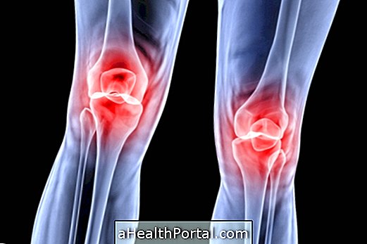 Bolečina pred kolenom je lahko Chondromalacia