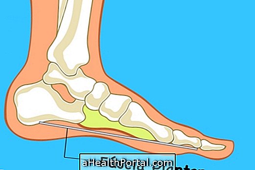 What is plantar fasciitis and how to treat it