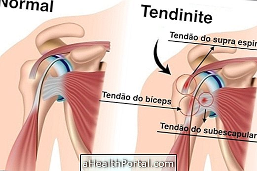 Behandling for tendonitis i skulderen