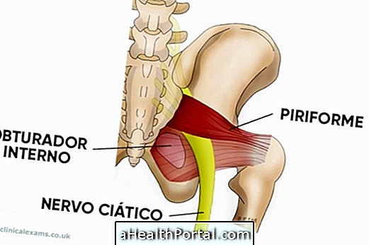 How to identify and treat Piriformis Syndrome
