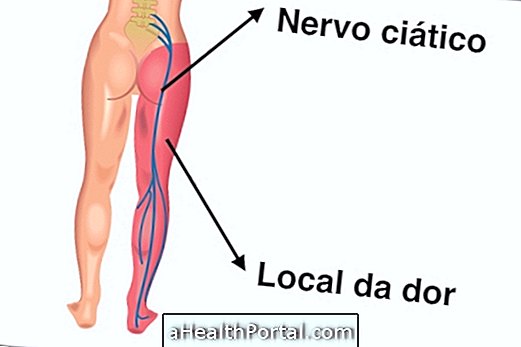 Symptomer og behandling af betændt sciatic nerve
