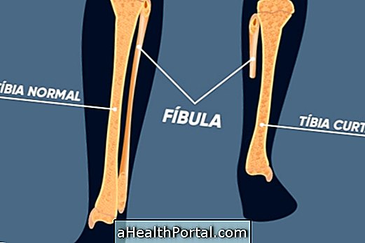 What is Hemimelia fibular and how to treat it
