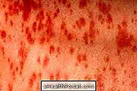 Difuzní kožní mastocytóza