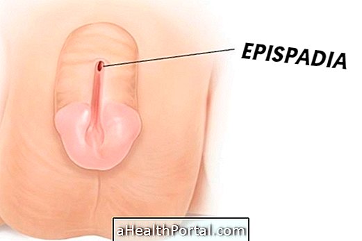 Epispadia là gì và cách điều trị nó
