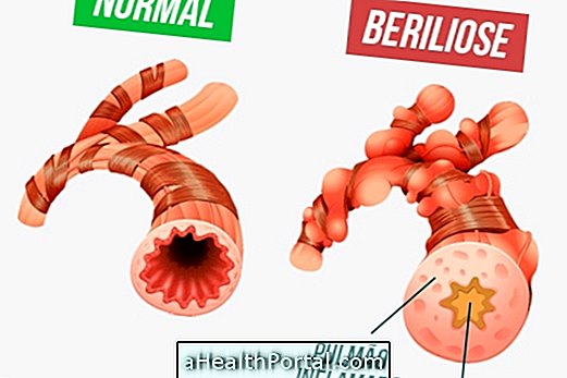 बेरीलियोसिस क्या है और इसका इलाज कैसे करें