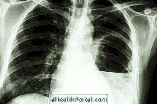 Mi a tüdőtest és hogyan kell kezelni?