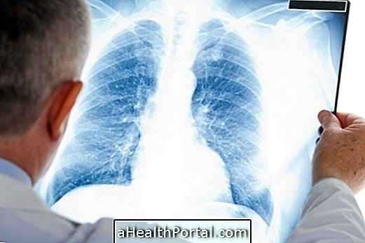 Pneumonie bilatérale: qu'est-ce que c'est, symptômes et comment traiter