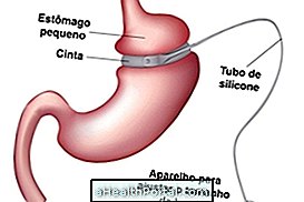 Gastric Banding for Weight Loss