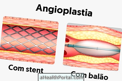 Cos'è l'angioplastica e come è fatta?