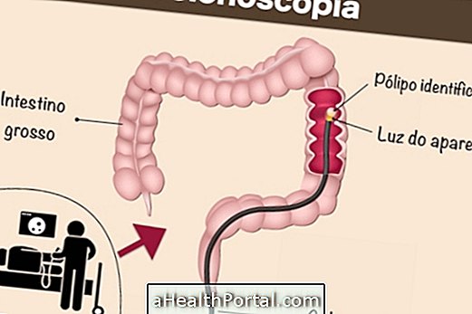 How is Colonoscopy done and what is it for?