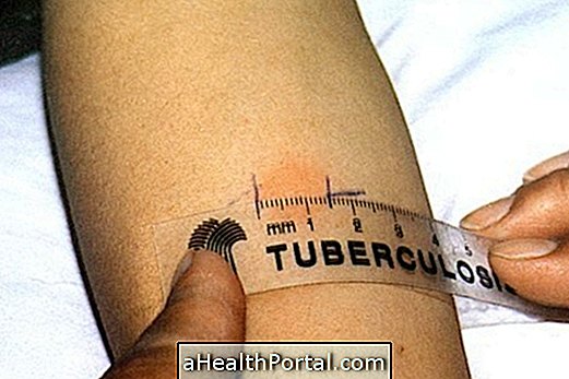 How is tuberculosis tested and results