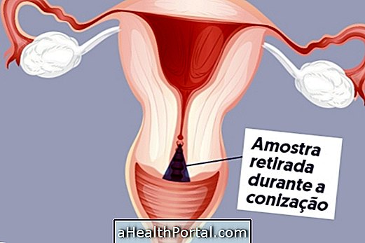 Conization of the uterus: What is it for and How is recovery