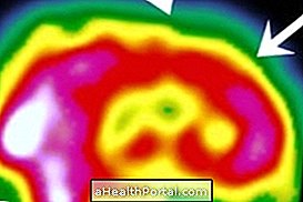 What is Brain Scintigraphy and how is it done?