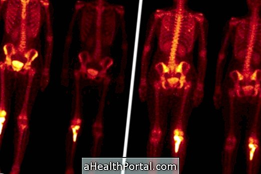 What is Bone Scintigraphy and what is it for?