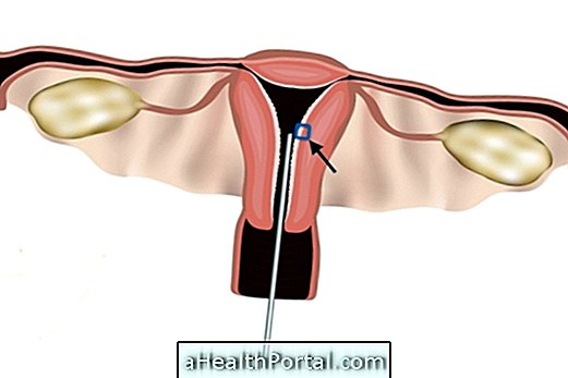 Learn how it is done and how to understand the result of the Uterine Biopsy
