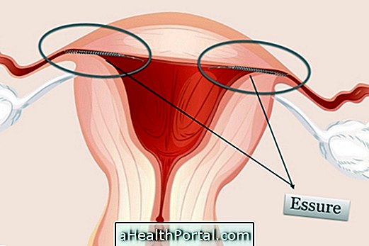 Main Side Effects of Ultimate Essure Contraception