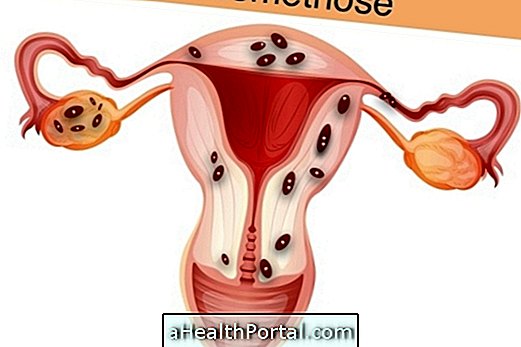 Endometriose under graviditet