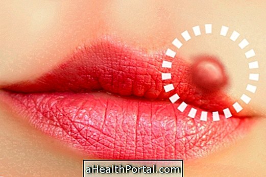 How To Treat Cold Sores In Pregnancy