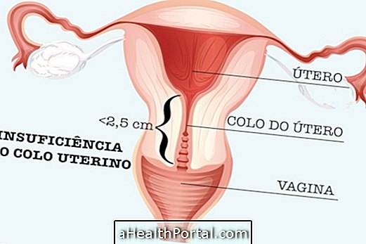 Qu'est-ce que l'insuffisance cervicale utérine?