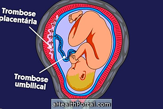 Thrombose placentaire et ombilicale: qu'est-ce que c'est, symptômes et traitement