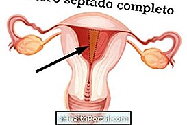 Verstehen Sie, warum der Uterus septate die Schwangerschaft schwierig machen kann