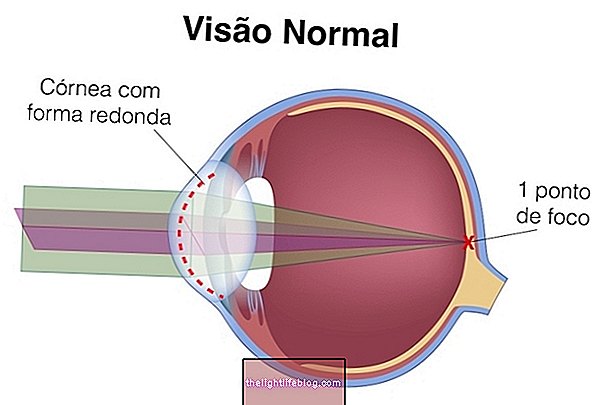 látás astigmatizmus okozza a kezelést