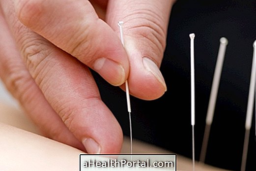 Qu'est-ce que l'acupuncture et à quoi ça sert