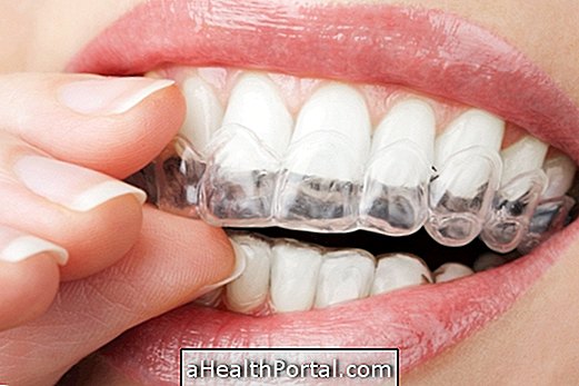 Kućni tretman za uklanjanje mrlja iz zuba