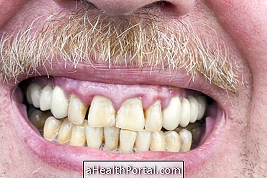Was ist ein Zahnfleischrückzug und wie soll er behandelt werden?