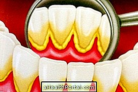 So entfernen Sie Zahnstein von den Zähnen