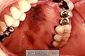 stomatologija - Glavni uzroci raka usta i što učiniti