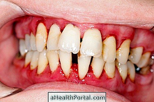 Soft and separated teeth may indicate disease