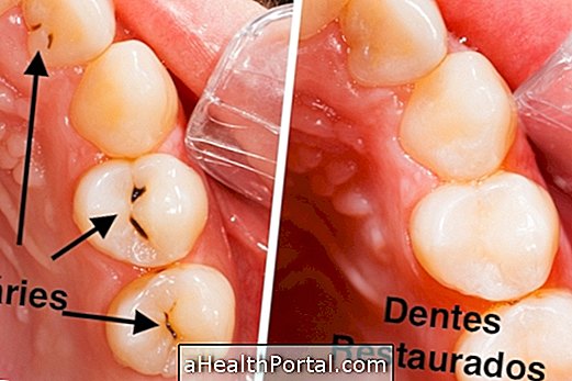 Kako prepoznati i liječiti zubni karijes