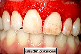 दंत चिकित्सा - गिंगिवाइटिस के लक्षण और लक्षण